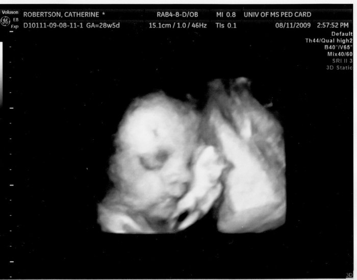 4-D ultrasound